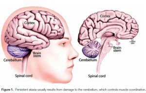 ataxia stem cell therapy