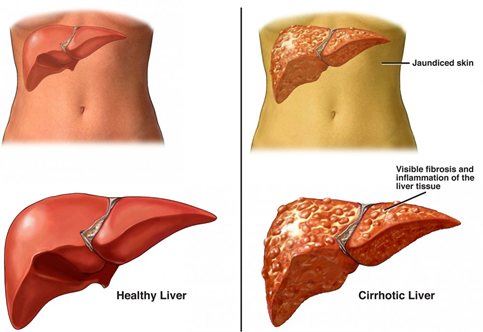 liver cirrhosis stem cell treatment, liver cirrhosis stem cells, liver disease stem cells, fatty liver disease stem cell treatment,