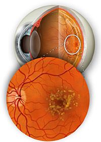 macular degeneration stem cell therapy