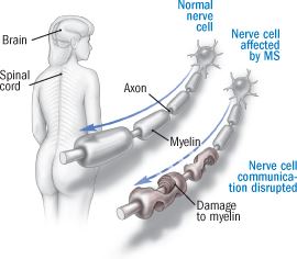 multiple sclerosis stem cell