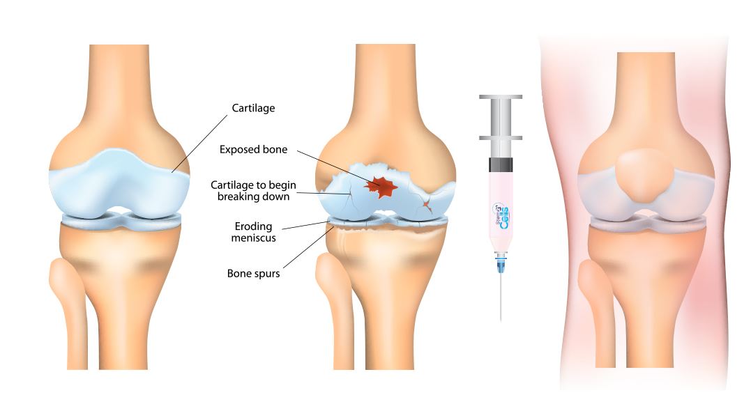 osteoarthritis stem cell treatment