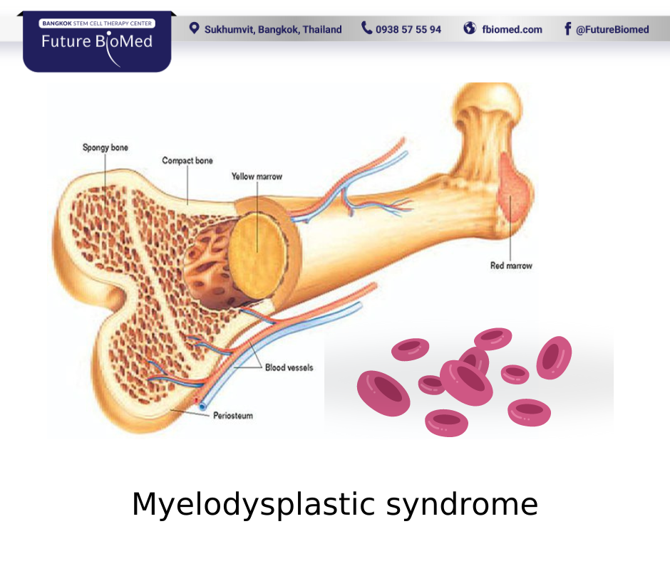 Tế bào gốc máu dây rốn trong điều trị hội chứng loạn sinh tủy