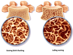 . Xương bình thường và loãng xương